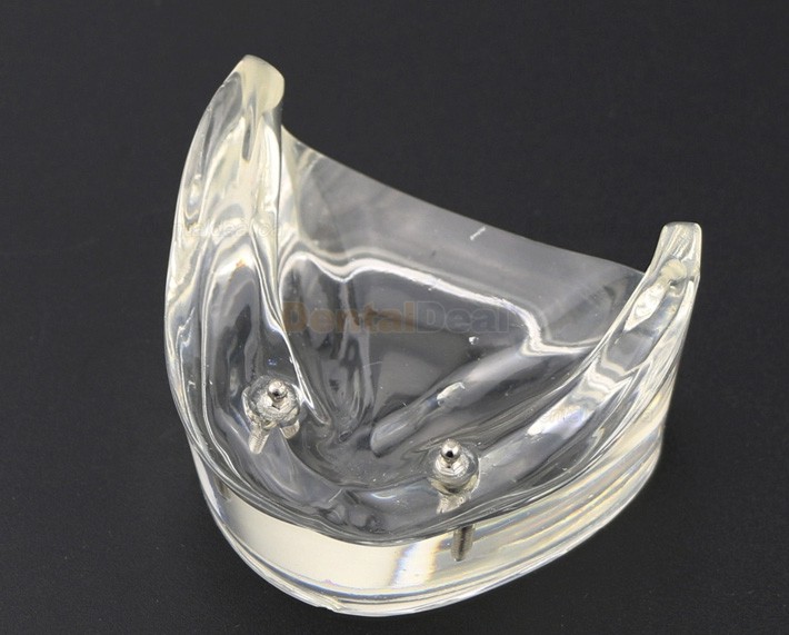 Dental Teeth Implant Overdenture Model Lower Jaw with 2 Implants Education Study Demo Model 6002 01